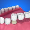 Tooth supported fixed bridge. Medically accurate 3D illustration