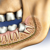removing-wisdom-teeth-illustration-c517aa